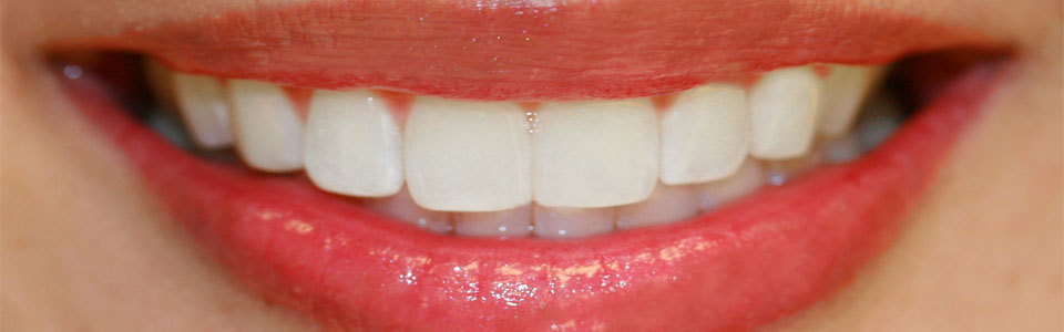 White Teeth and Healthy Mouth – Naturally!